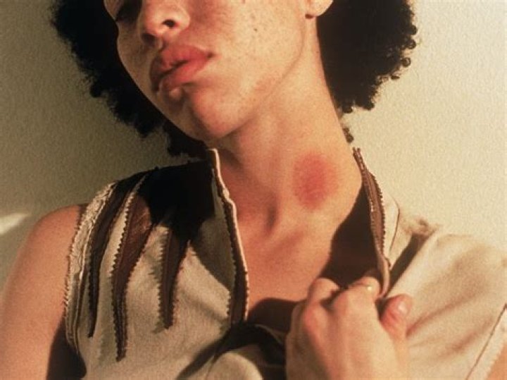 Can Hickeys Cause Cancer? Separating Fact from Fiction