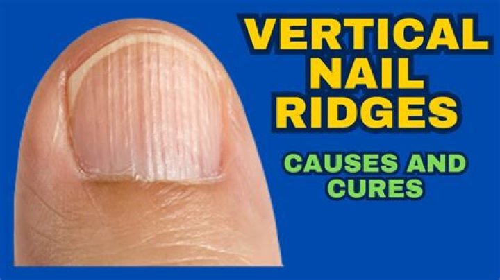 Nail Ridges Remedy: Comprehensive Guide to Understanding and Treating Nail Ridges