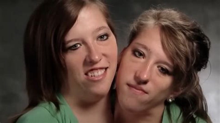 Understanding the Life and Legacy of Abby and Brittany Hensel: What is the Cause of Death?